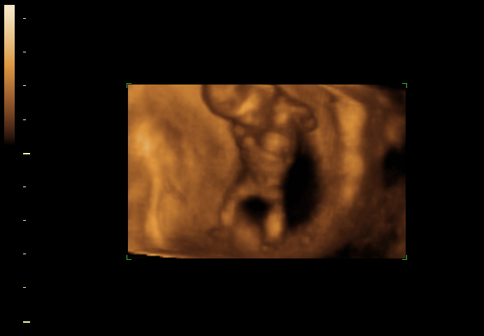 3D ultrasound image at 12 weeks